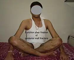 Function after fixation