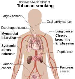 head and torso of a male with internal organs shown and labels referring to the effects of tobacco smoking