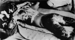 A victim with whole body burns