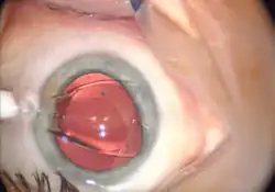 The lens is mostly unfolded, behind the iris