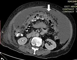 medical image showing thickened greater omentum