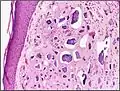 Histopathology of calcinosis cutis in human tissue