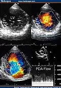 Transthoracic two-dimensional study with color and continuous wave Doppler shows left ventricular noncompaction associated with patent ductus arteriosus (PDA). [2]