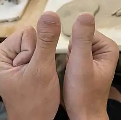 Brachydactyly type D.