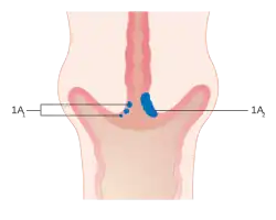 Stage 1A cervical cancer