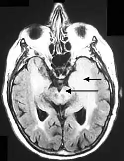 Axial fluid-attenuated inversion recovery MRI image demonstrating tumor-related infiltration involving both temporal lobes (Short arrow), and the substantia nigra (Long arrow).