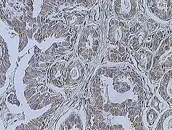 Immunohistochemistry of breast cancer (Infiltrating ductal carcinoma of the breast) assayed with anti HER-2 (ErbB2) antibody.