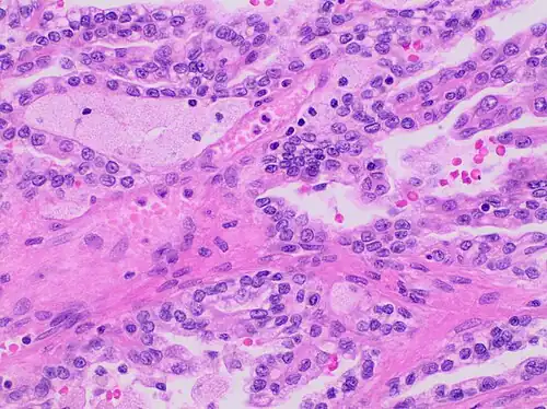 A micrograph of type 1 PRCC, illustrating features of small basophilic cells with scarce cytoplasm. A single layer of cells are surrounding the basal membrane.[20] Foamy macrophages are inside of papillary fibrovascular cores.