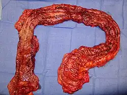Colon resection