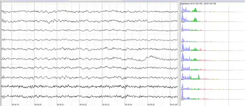 Human EEG with in resting state. Left: EEG traces (horizontal – time in seconds; vertical – amplitudes, scale 100 μV). Right: power spectra of shown signals (vertical lines – 10 and 20 Hz, scale is linear). 80–90% of people have prominent sinusoidal-like waves with frequencies in 8–12 Hz range – alpha rhythm. Others (like this) lack this type of activity.