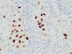 Immunohistochemistry stain for SOX10 in a poorly differentiated metastatic melanoma to a lymph node, helping in its diagnosis.