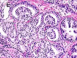 Gleason score 8 (4+4) with glomeruloid glands