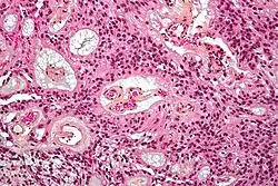Micrograph of a myxopapillary ependymoma. HPS stain.