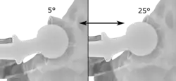 Acetabular anteversion is normally between 5 and 25°.[16] An anteversion below or above this range increases the risk of dislocation.[16] There is an intra-individual variability in this method because the pelvis may be tilted in various degrees in relation to the transverse plane.[16]