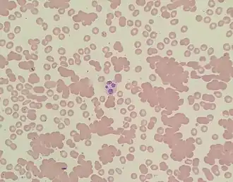 A photomicrograph of a blood smear showing red blood cells in clumps
