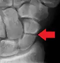 A more obvious scaphoid fracture on a scaphoid view X ray