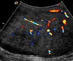 Fig. 19. Fibrous pseudotumor. With color Doppler, a little vascular flow is seen in this fibrous pseudotumor.[citation needed]