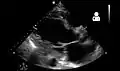 Ultrasound showing severe systolic heart failure[72]