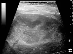 Renal ultrasonograph of acute pyelonephritis with increased cortical echogenicity and blurred delineation of the upper pole[20]
