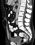 Midsagittal CT scan of a man's abdomen showing the urachus