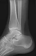 Lateral oblique (to visualize the posterior border of the tibia)