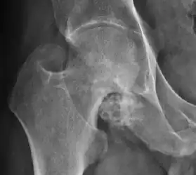 X-ray of synovial chondromatosis.[1]